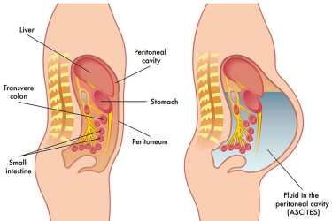 Ascites Treatment in Bhiwani Haryana, Best Liver Specialist for Ascites in Bhiwani, Dr Mayank Chugh Best Gastroenterologist for Ascites