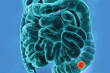 Colon Cancer Treatment in Bhiwani, Dr Mayank Chugh, Best Gastroenterologist in Haryana