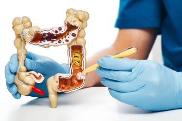 Colon Cancer Treatment in Bhiwani, Dr Mayank Chugh, Best Gastroenterologist in Haryana