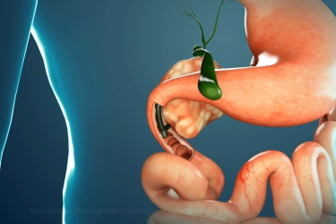 CBD Stone Treatment, ERCP in Bhiwani, Dr Mayank Chugh, Best Gastroenterologist for ERCP in Haryana