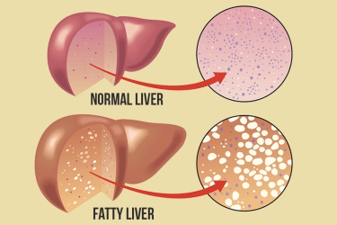 Fatty Liver Treatment in Bhiwani, Best Gastroenterologist in Haryana, Best Liver Doctor for Fatty Liver in Bhiwani, Dr Mayank Chugh