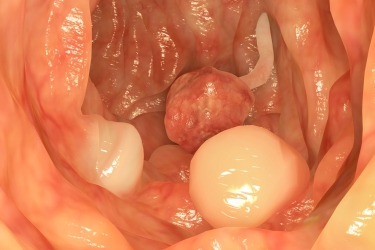 Colon Polyps Treatment in Bhiwani, Best Gastroenterologist in Haryana, Dr Mayank Chugh