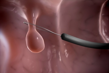 Colon Polyps Treatment in Bhiwani, Best Gastroenterologist in Haryana, Dr Mayank Chugh